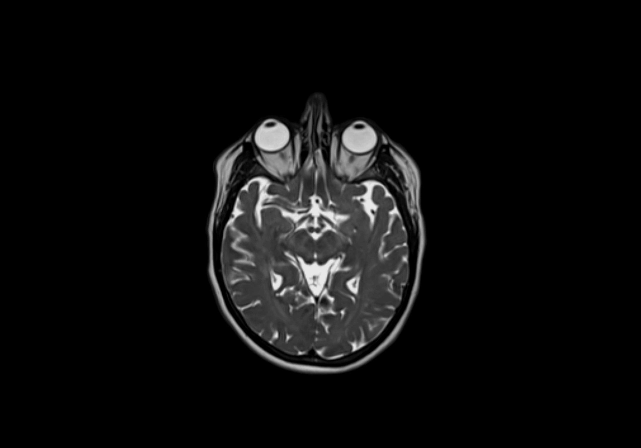 Neck axial  lymph node cross sectional MRI anatomy 3T MRI  image-img-00001-00001.webp
